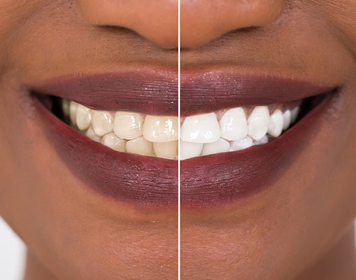 Patient's smile before and after teeth whitening