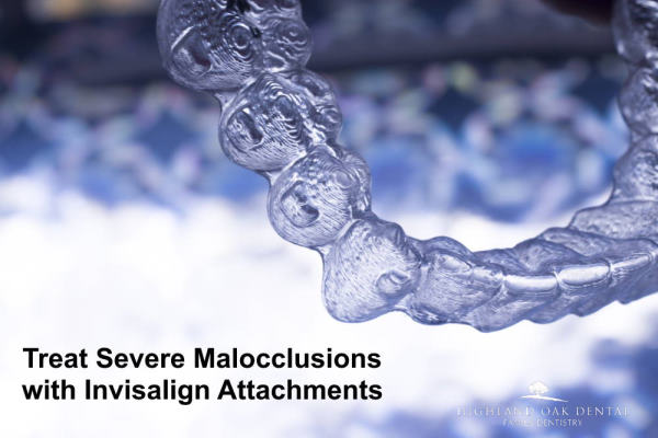 Invisalign Attachments: A Discreet Solution for Treating Severe Malocclusions
