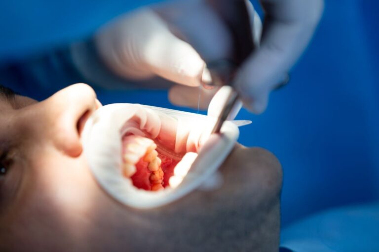 Root Canal Therapy: Your Guide to a Pain-Free Smile!