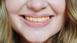 Woman with stained teeth