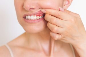 Nose-to-shoulder view of woman pulling back upper lip to reveal dark gums