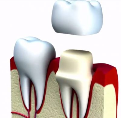 Dental Crown Frisco
