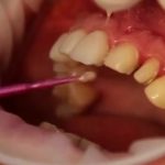 Dental Veneers Frisco