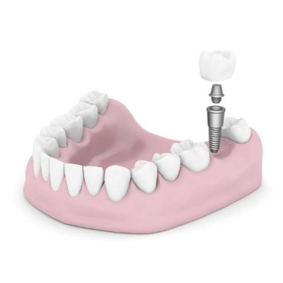 dental implants near me