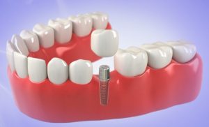 Dental Implants Replace Missing Teeth