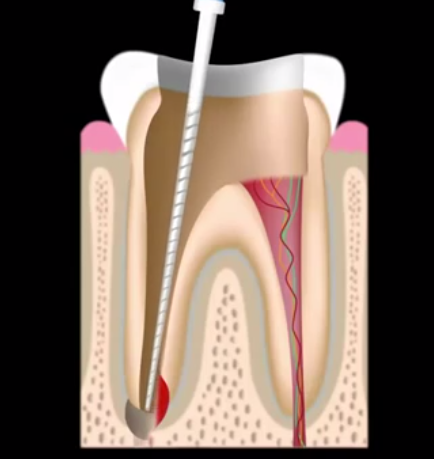 Lewisville Root Canal