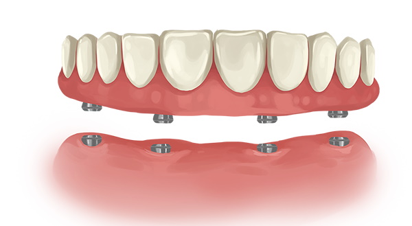 Price of dental implant supported dentures