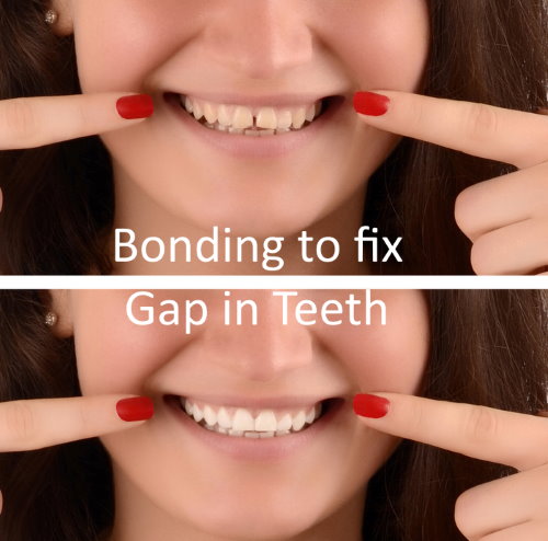 Tooth Bonding Frisco - Highland Oak Dental