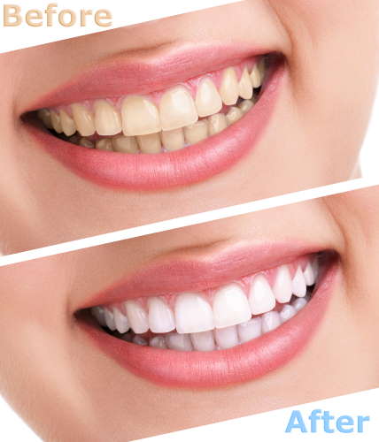 Teeth whitening price