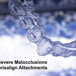 Invisalign Attachments: A Discreet Solution for Treating Severe Malocclusions