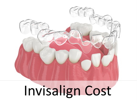 Price of treatment with Invisalign