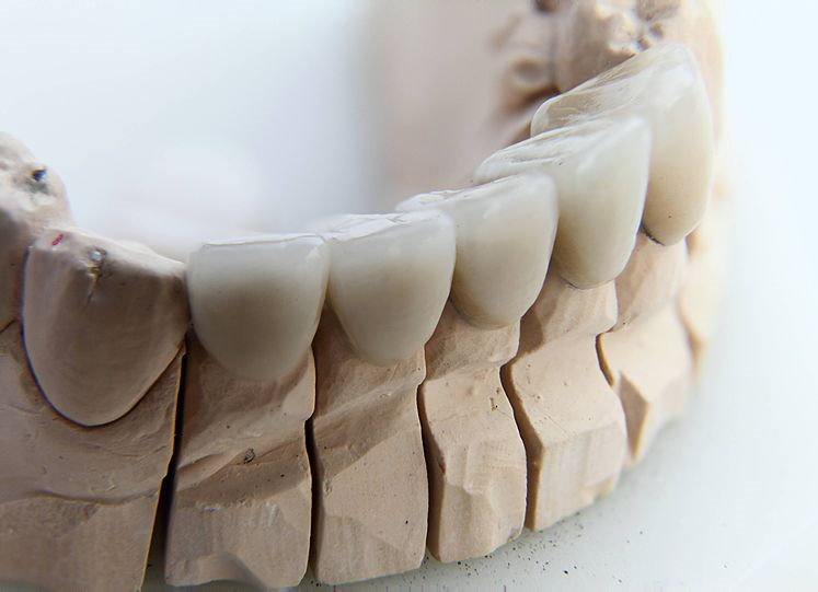 Dental Crown Cost How Much Is A Tooth Crown - Porcelain 2021