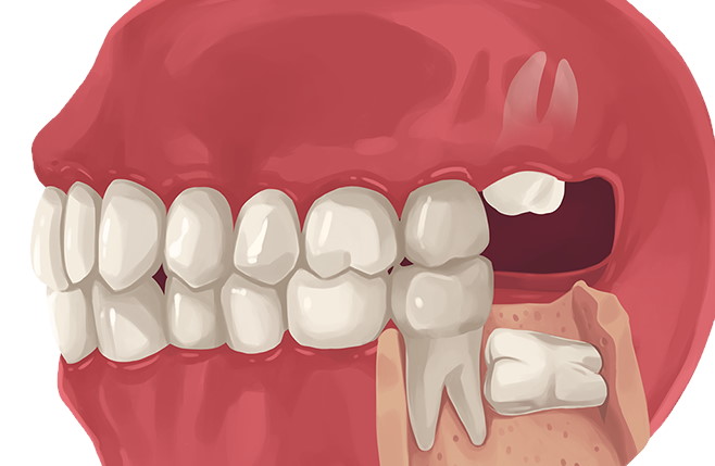 Wisdom teeth removal - The Colony, TX | Texas - Cost, Emergency - Highland  Oak Dental